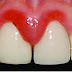 Nguyên nhân bọc răng sứ bị viêm lợi bạn nên cảnh giác