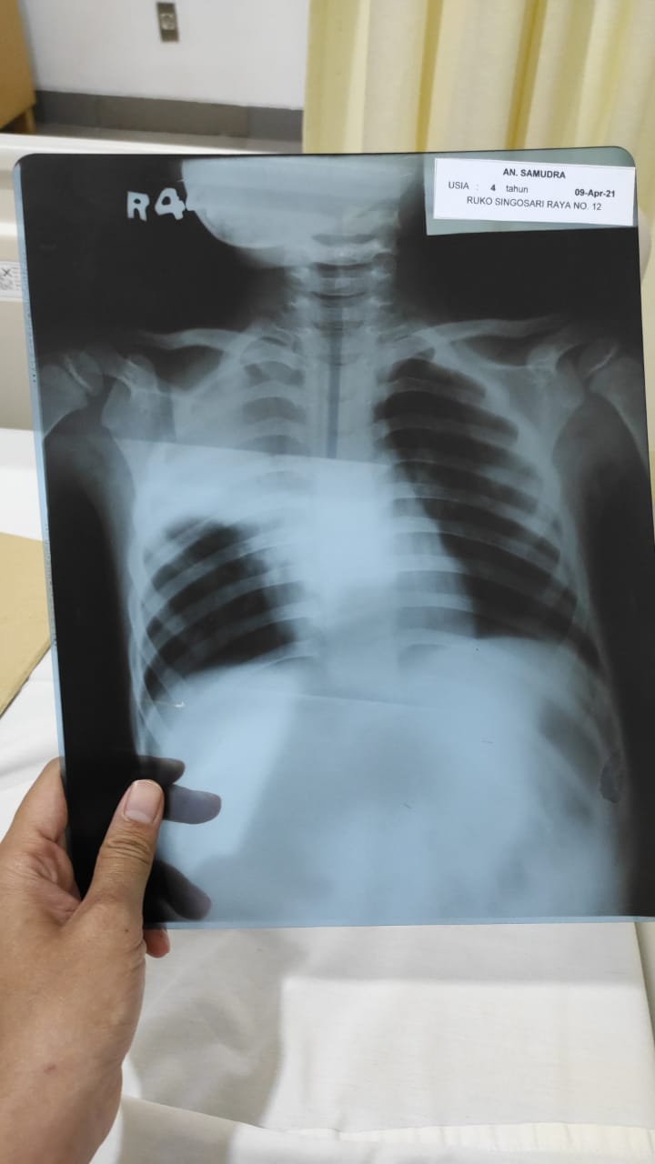 gambar rontgen paru paru anak sakit pneumonia