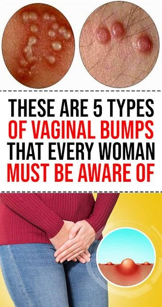 pimple bump on vagina pimple bump on vagina