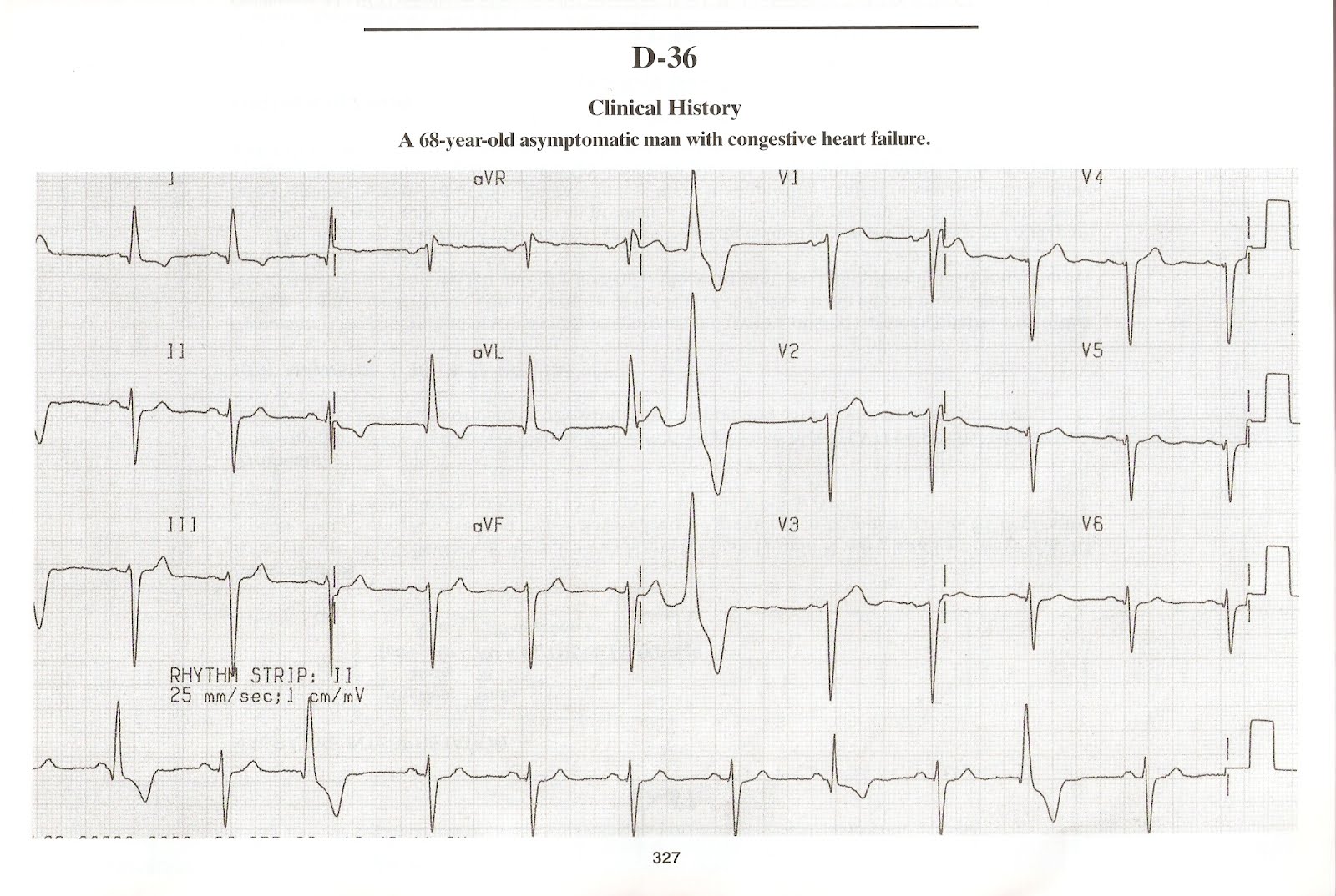 левожелудочковая недостаточность на экг. хроническая коронарная недостаточность на экг что это. экг при хронической сердечной недостаточности. инфаркт предсердий на экг. хроническая коронарная недостаточность на экг что это.