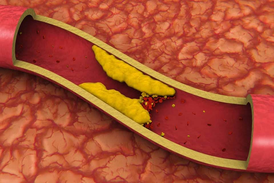 Colesterol. Foto: James Benet/Gety Images