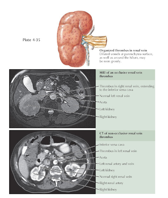 RENAL VEIN THROMBOSIS pediagenosis