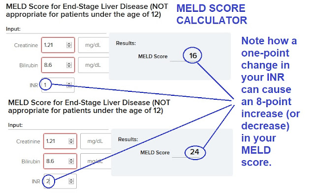 meld na score interpretation meld na score interpretation