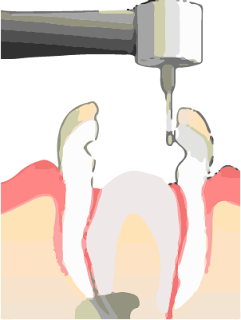 pulpotomy procedure