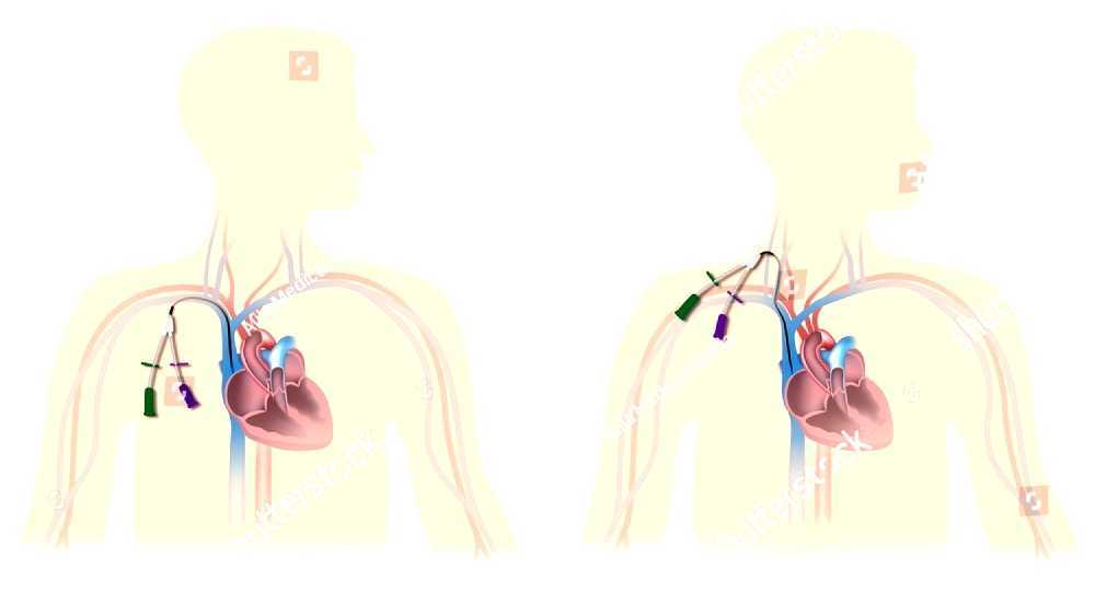Central venous catheter