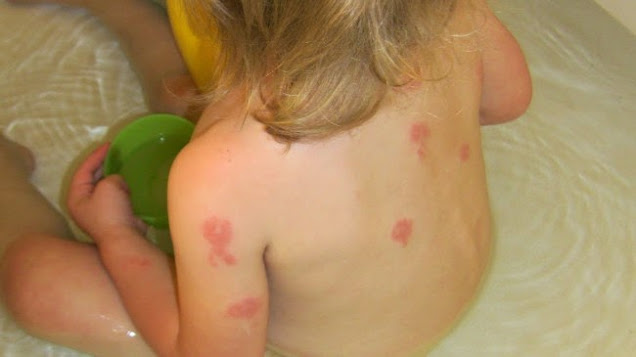 Πρώτες βοήθειες για καλοκαιρινά τσιμπήματα