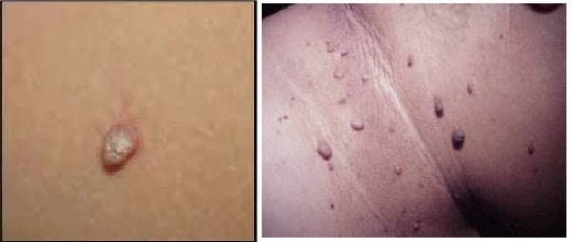 verrugas genitales en el ano en niños