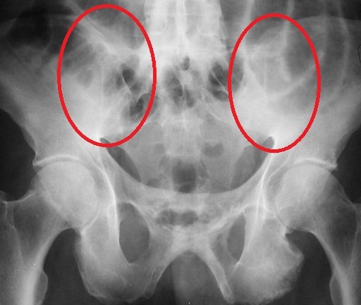 SACROILIAC JOINT DYSFUNCTION