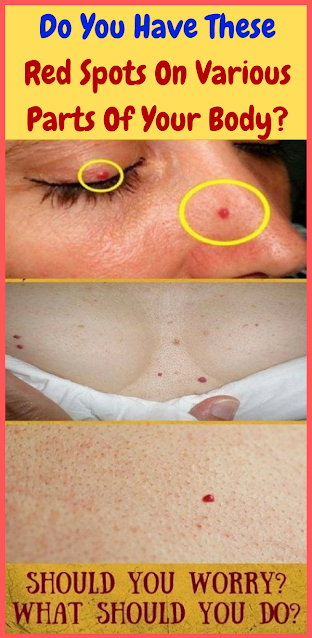 Do You Have These Red Spots On Various Parts Of Your Body!