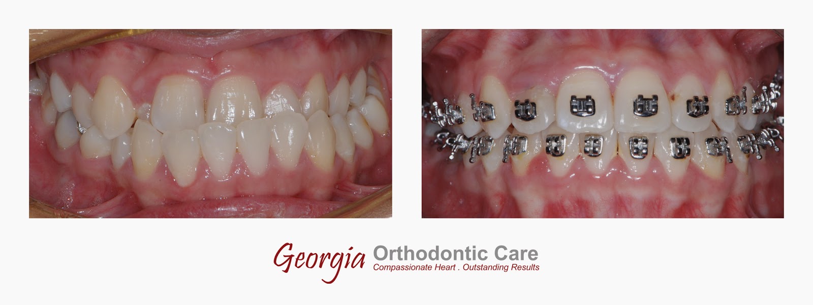 ORTHODONTIC CARE LAWRENCEVILLE & NORCROSS GA December 2014