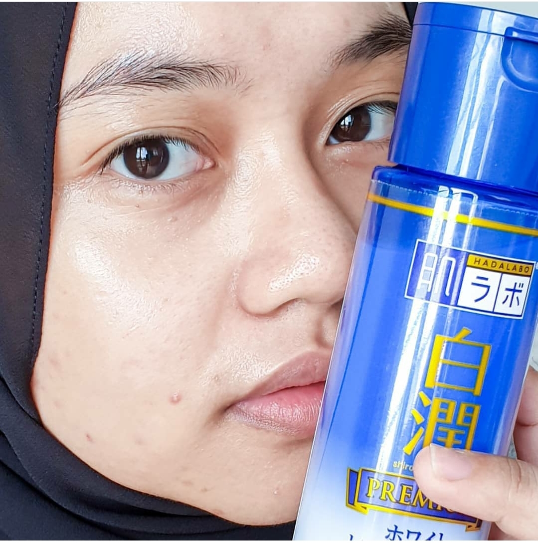 IS HYALURONIC ACID SUITABLE WITH ACNEPRONE SKIN? HOW HYALURONIC ACID