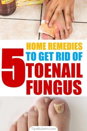 How to Get Rid of Toenail Fungus - medicine health life