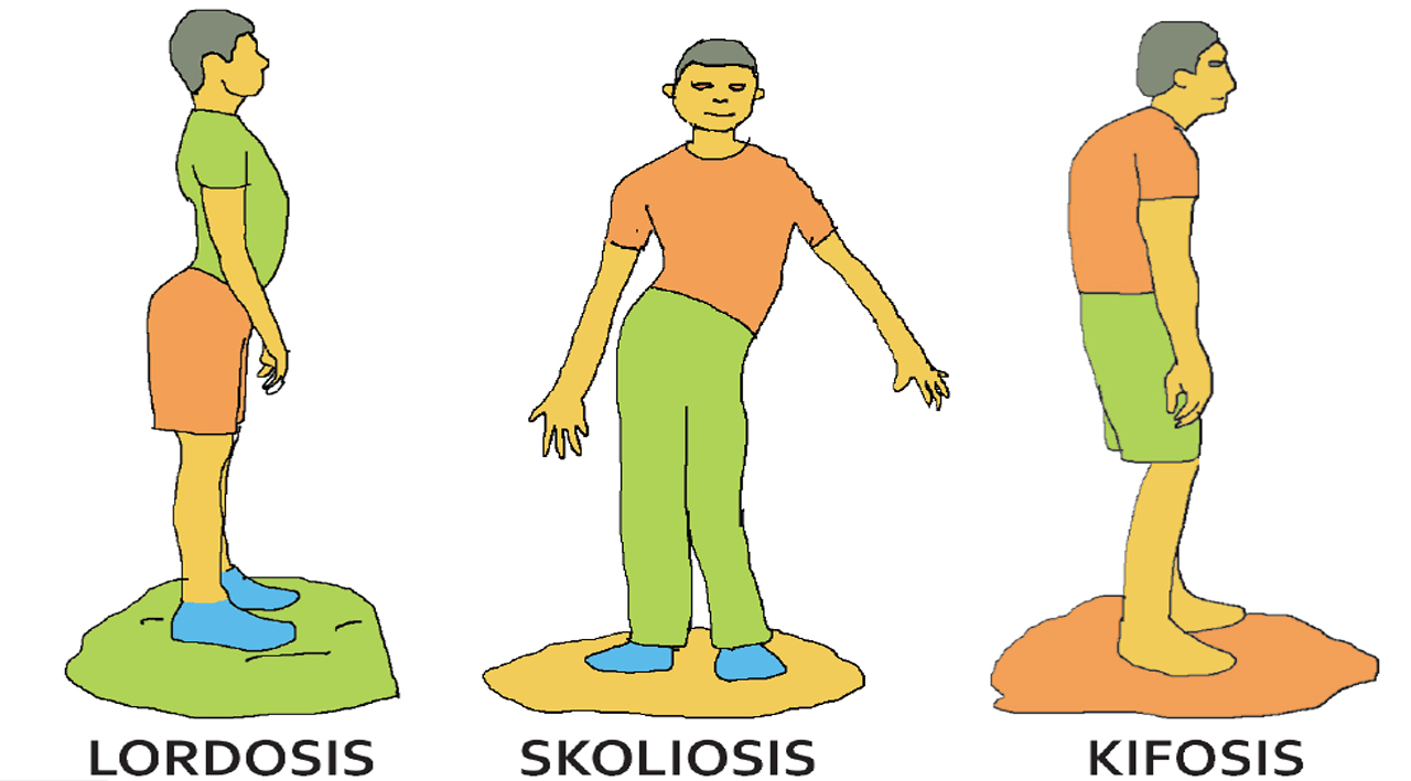 Contoh Soal Kelainan Tulang Posisi Badan Bungkuk 2016
