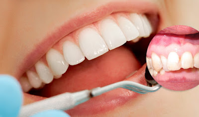 Bọc răng sứ cho răng cửa bị hô hiệu quả không? 