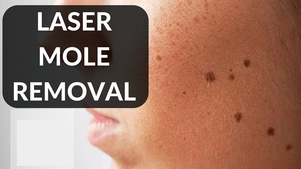 Mole Removal Surgery by Dr Kumar Skin Hair & Cosmetic Clinic Bareilly