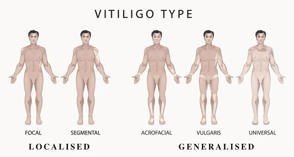 El vitiligo no tiene cura-Tipos de Vitiligo