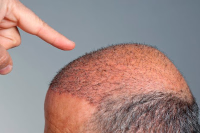 Hair transplant procedure changing Hair transplant: A life-changing procedure - Hair Transplant