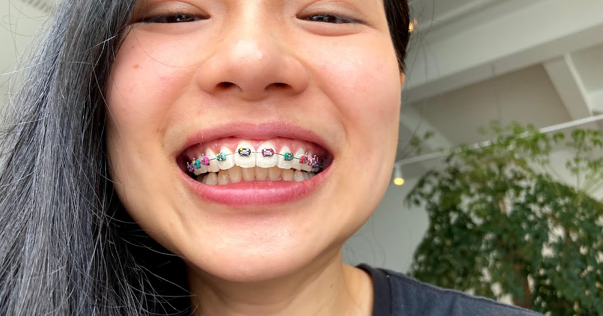 Angeline Loh Braces In Johor Bahru Isihat Dental