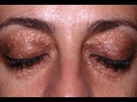 6 Cara Mudah Yang Korang Boleh Amalkan Untuk Hilangkan Biji Kolestrol