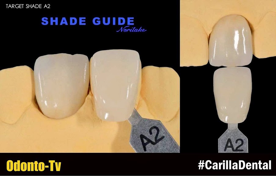CARILLAS DENTALES Refractarias Noritake con Cemento Panavia