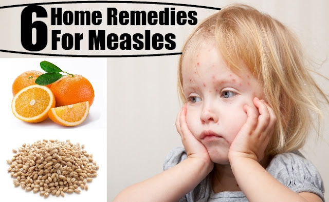 खसरा का घरेलू इलाज,Home Remedies for The Treatment of Measles in Hindi,