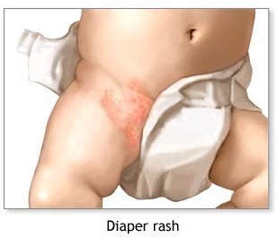 diaper rash care