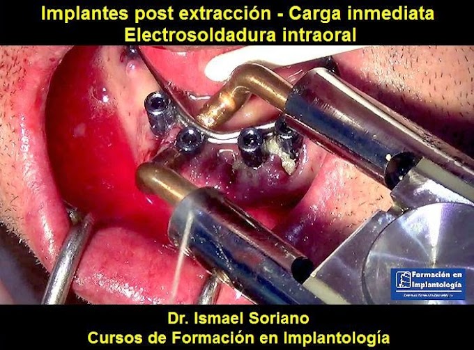 IMPLANTOLOGÍA: Implantes post extracción - Carga inmediata - Electrosoldadura intraoral