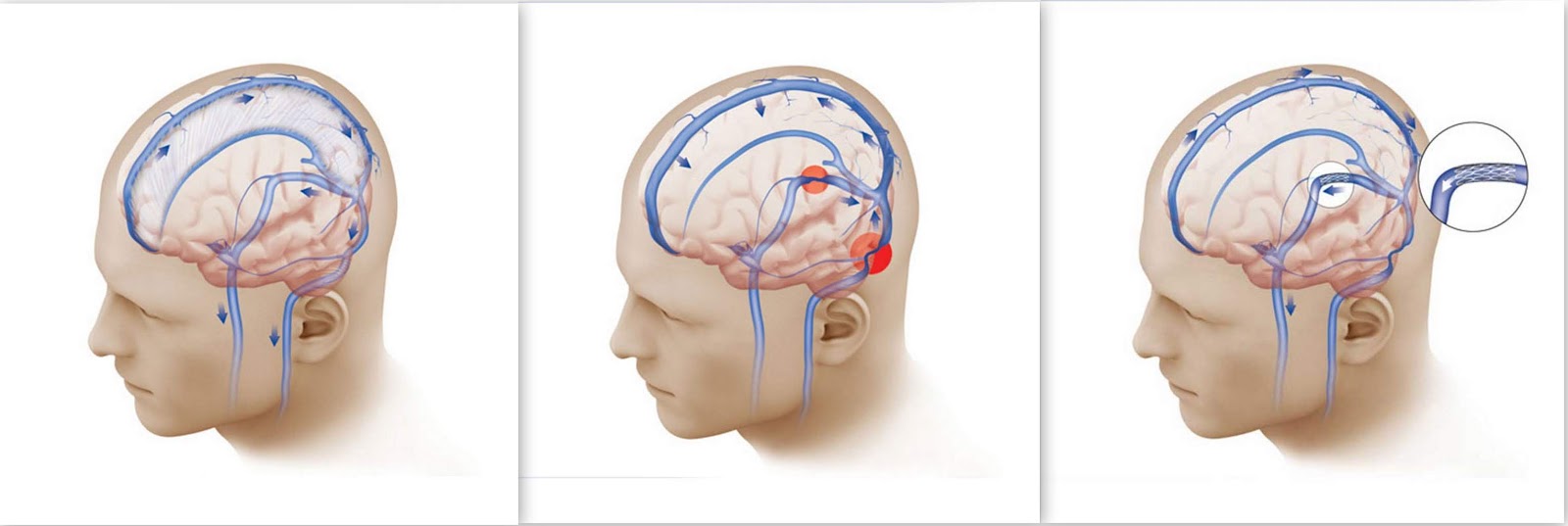 Ангиодистония сосудов. Венозный отток головного мозга. Затруднение венозного оттока головного мозга. Венозный отток крови головы.