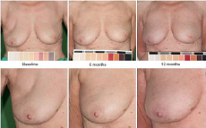 affected breast