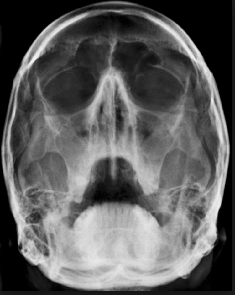 What To Do With a Broken Nose? Fauquier ENT Blog