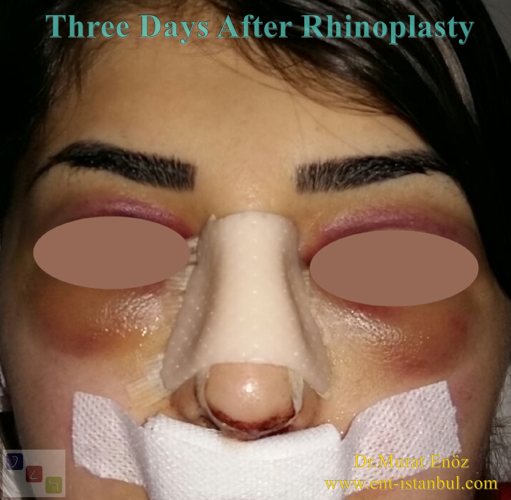 Rhinoplasty Healing Properties by Week and Month