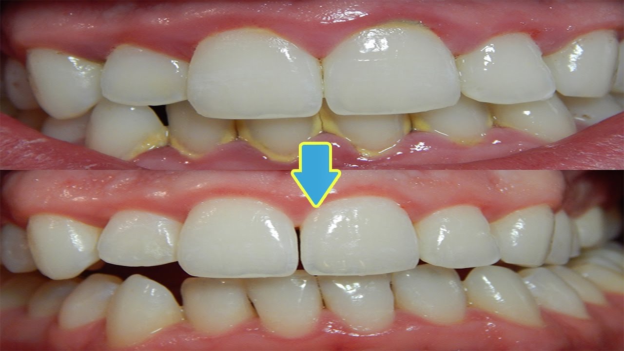 4 Tis to Whiten Yellow Teeth And Remove Plaque And Tartar Buildup