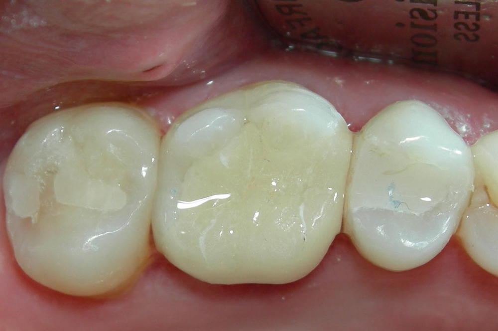 Which Filling Material Is Suitable For Your Teeth