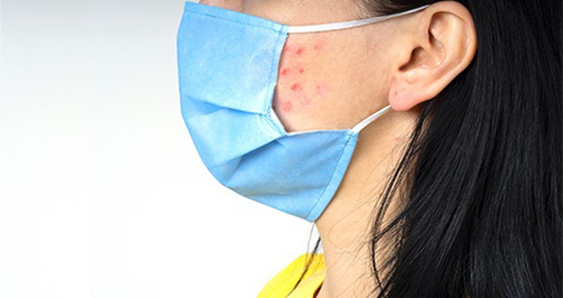 Maskne