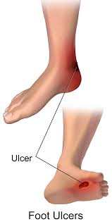 Diaibetic foot ulcer in hind,  डाइबिटिक फुट के लक्षण और  इलाज, diabetic alsar ka ilaj, diabetic alcar care tips, daibetic foot care tips in hindi, what is diabetic foot in hindi