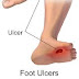 Diabetic foot ulcer in hindi- डाइबिटिक फुट अल्सर के लक्षण और  इलाज