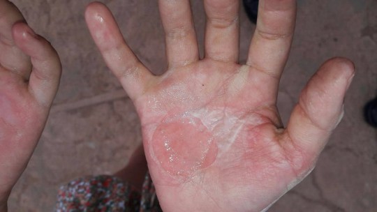 Resultado de imagem para Mãe que queimava o filho como forma de punição é presa