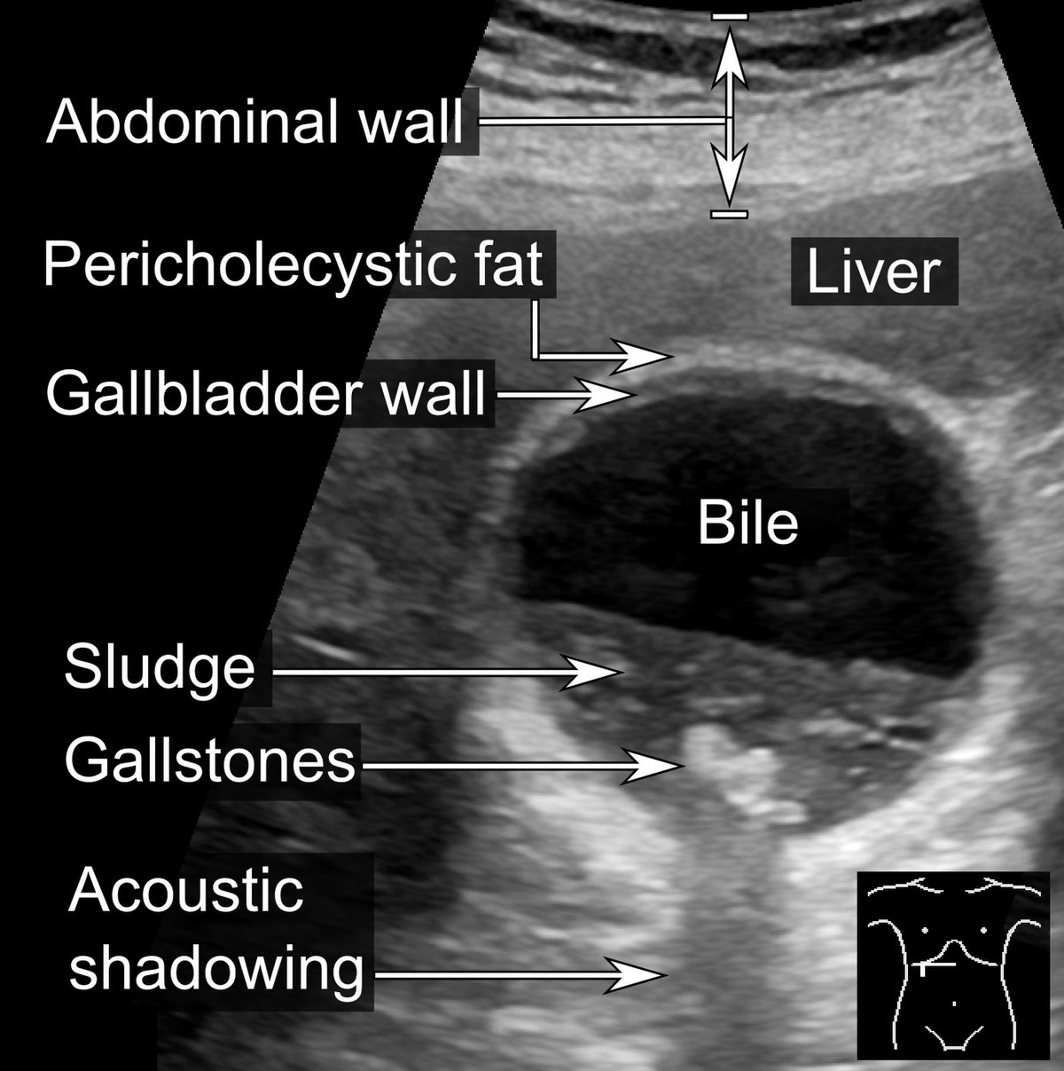 MEDICAL ULTRASOUND GALL BLADDER STONE medical-ultrasound-gall-bladder-stone