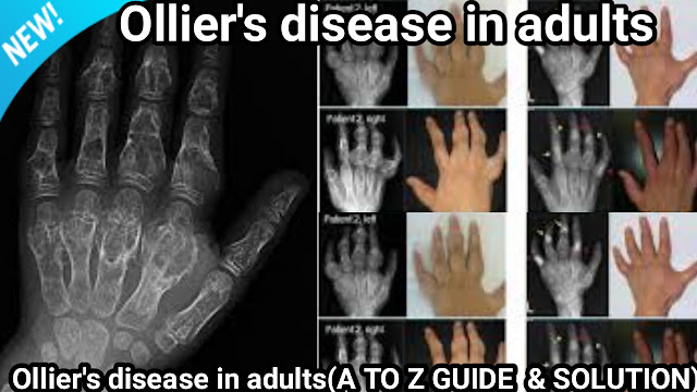 Ollier's and Maffucci syndrome Radiology, Maffucci syndrome,Ollier disease Orthobullets,Ollier disease wiki,Ollier disease radiology,Ollier's disease ppt, Ollier's disease in adults,Ollier disease multiple enchondroma