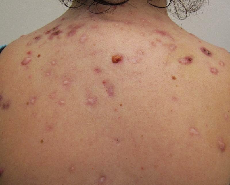 How to Get Rid of Acne on Your Back Within 3 Days