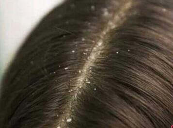 أسباب قشرة الشعر 