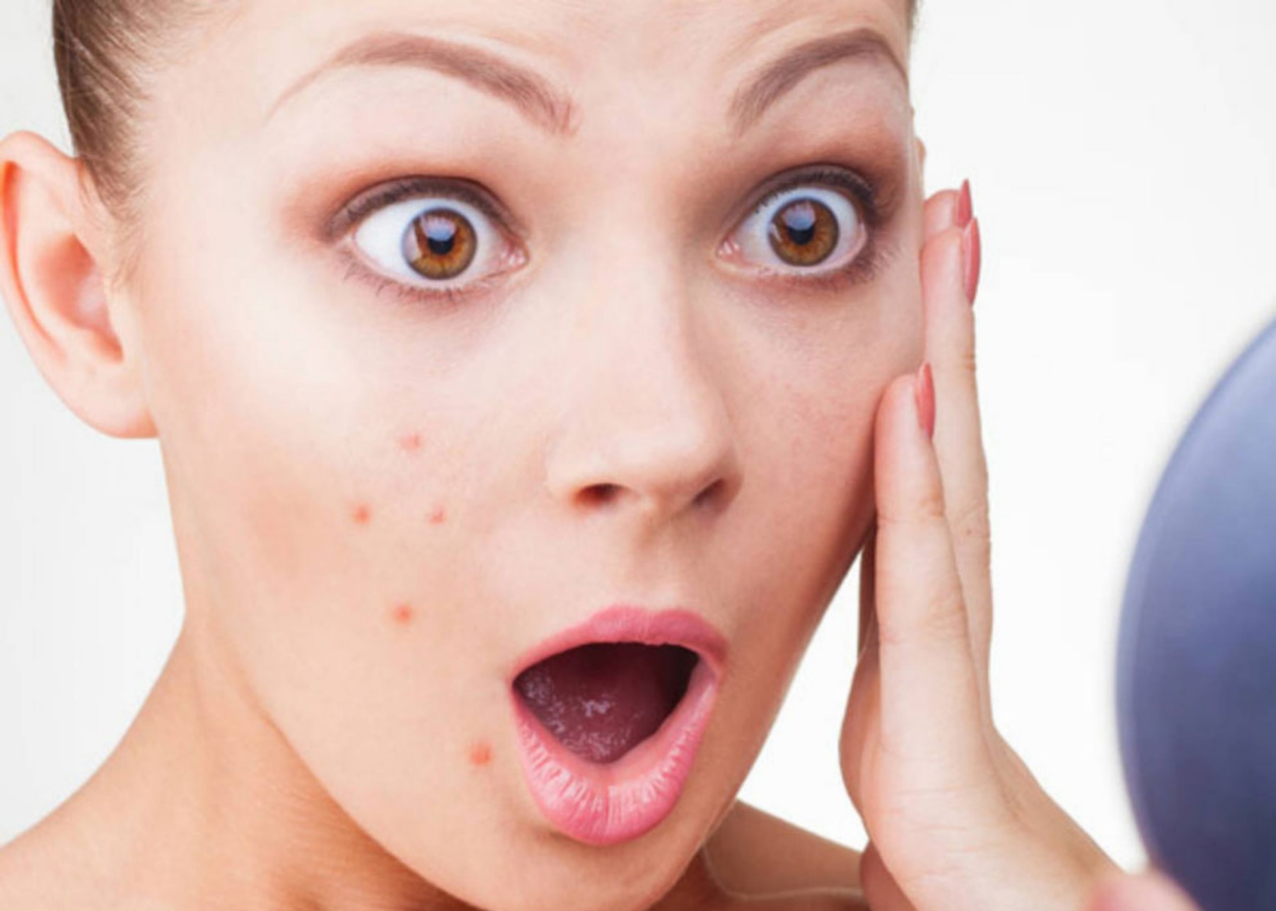 How to Remove Pimples Naturally and Permanently in One Day at Home