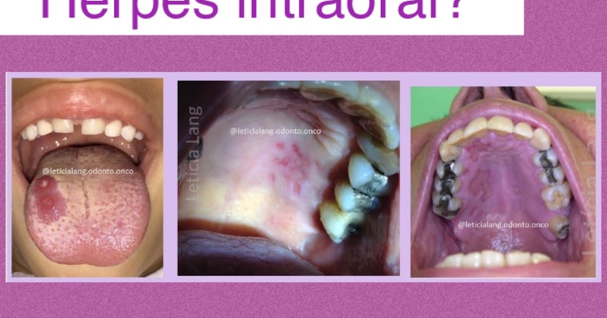 Letícia Lang Odontooncologia Herpes intraoral?