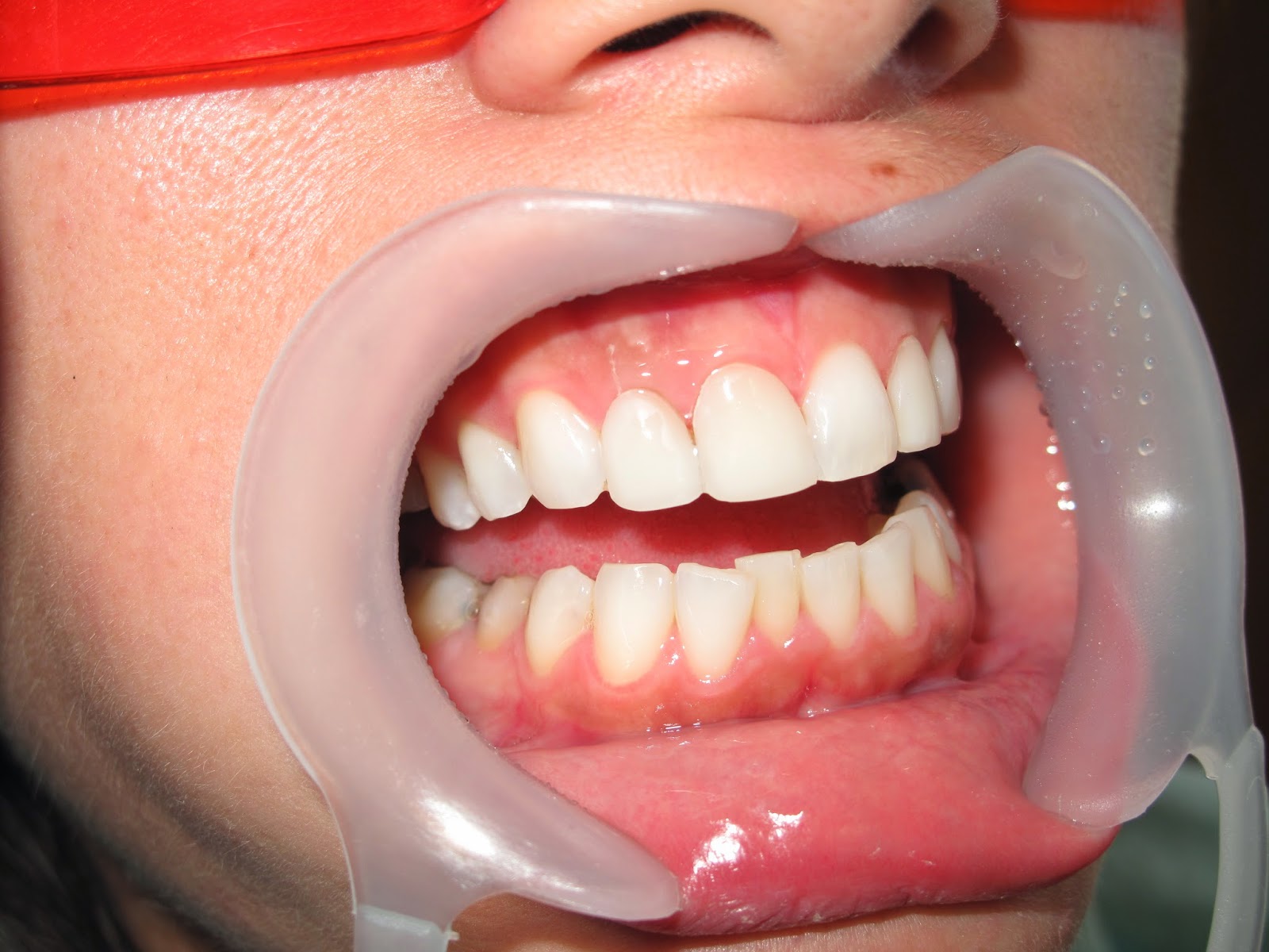 One of the best dental implants laser specialist surgeon in Lebanon