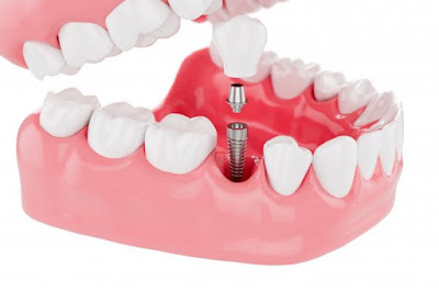 Địa chỉ trồng răng implant ở đâu tốt tại tphcm 1