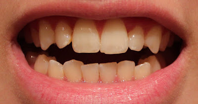 Làm trắng răng khi nhiễm tetracycline như thế nào?