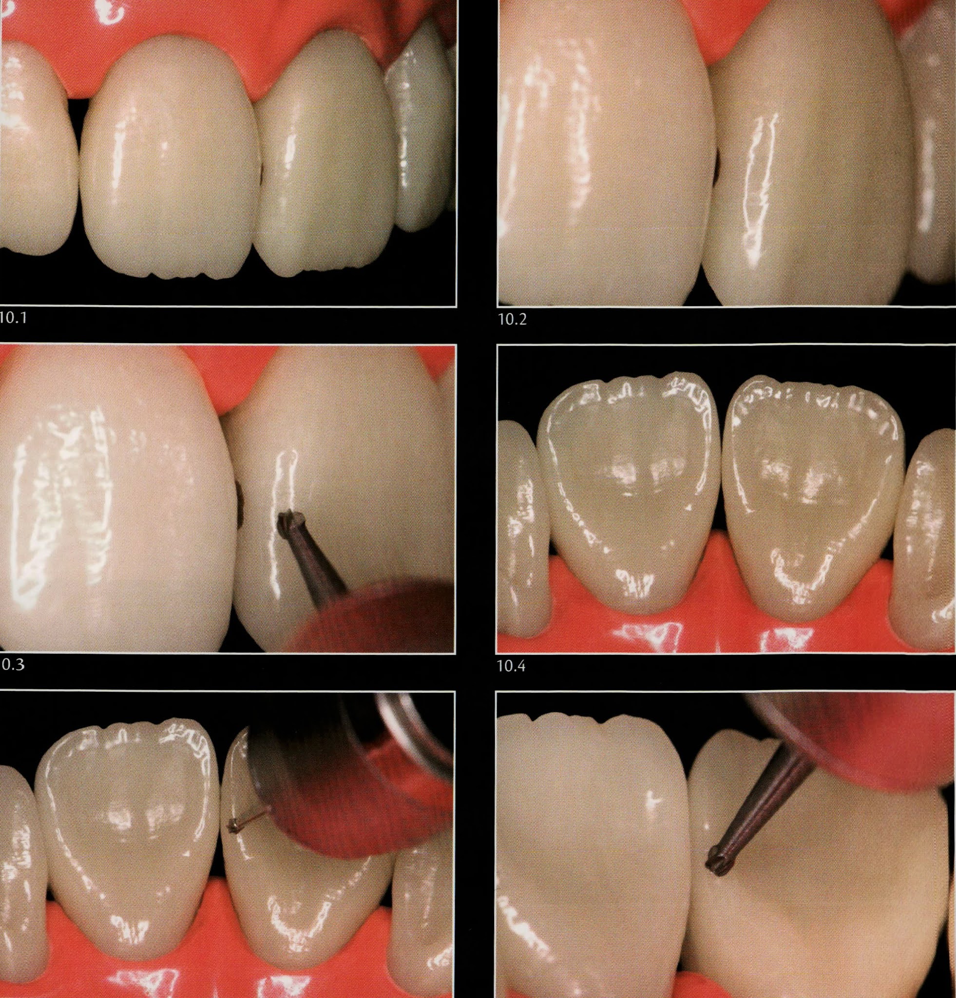 Class III composite restoration “ strictly proximal access “ Dental