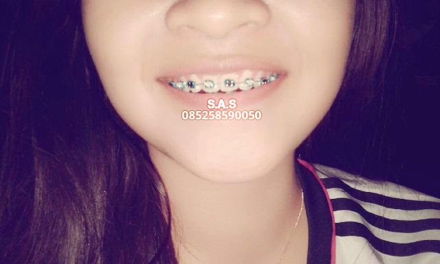 Koleksi Foto Senyum Behel Cantik dan Model Warna Karet Koleksi Foto Senyum Behel Cantik dan Model Warna Karet