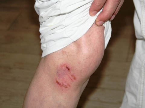 Βέροια: Αγέλη αδέσποτων επιτέθηκε σε ηλικιωμένο και τον δάγκωσαν στο πόδι