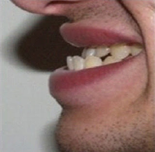 Phương pháp niềng răng móm